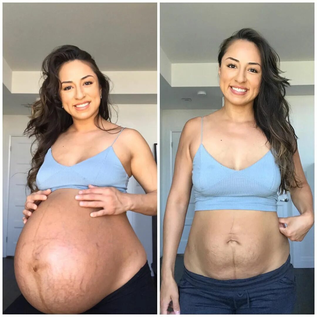 До и после беременности фото. Живот после родов двойни. Живот после беременности. Животживот поле беремености.