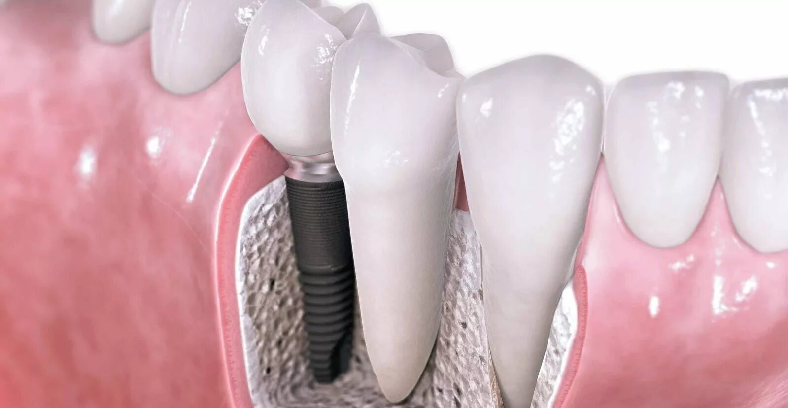 Через сколько можно вставить зубы. Astra Tech импланты. Костная пластика (остеопластика). Имплантаты Dentium Superline. Премиум-импланты зубов Astra Tech.