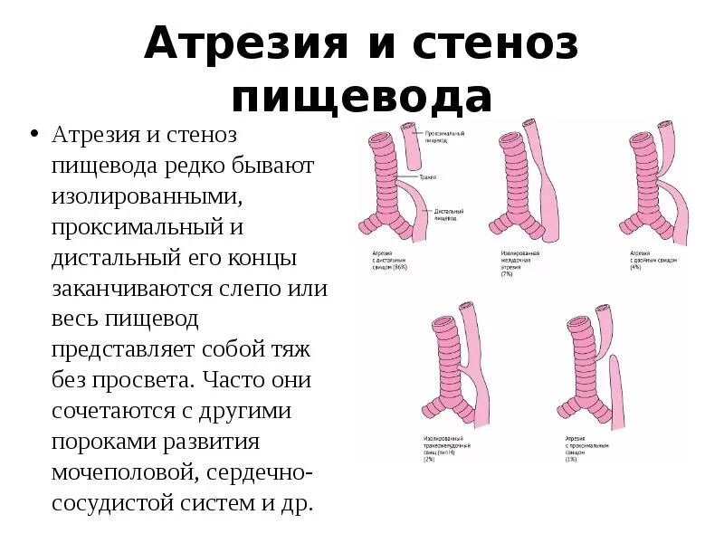 Пищевод у новорожденного. 1. Атрезия пищевода. Трахеопищеводный свищ?. Атрезия пищевода этиопатогенез. Атрезия пищевода с трахеопищеводным свищем ?.