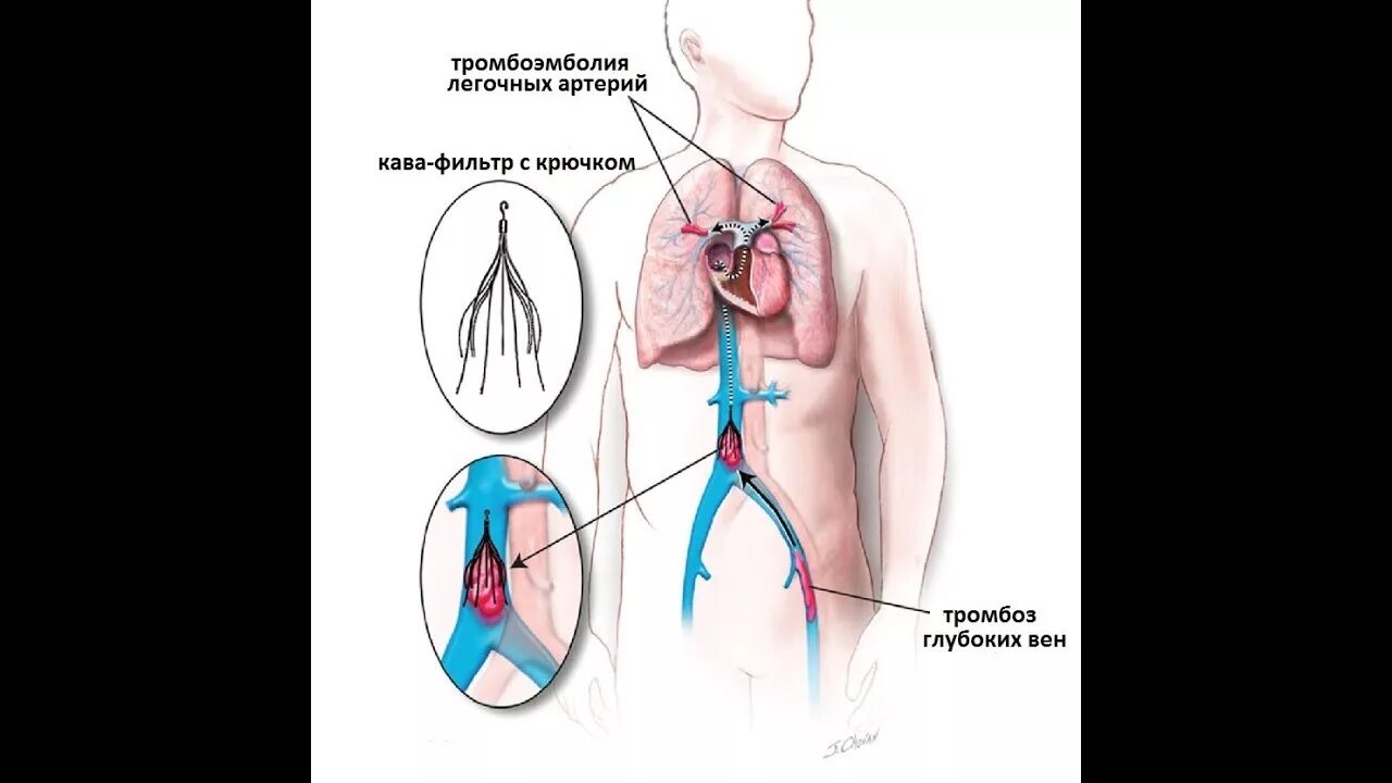 Нижняя полая Вена с кава фильтром. Имплантация кава-фильтра. Тромбоз тэла