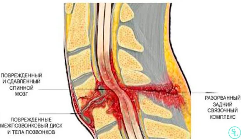 Отдел разрыв. Компрессионная миелопатия поясничного отдела. 5) Миелопатия. Миелопатия поясничного отдела спинного мозга. Компрессионная миелопатия спинного мозга.