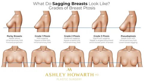 Sagging Breasts Classification - Saggy Breast Ptosis Classification.