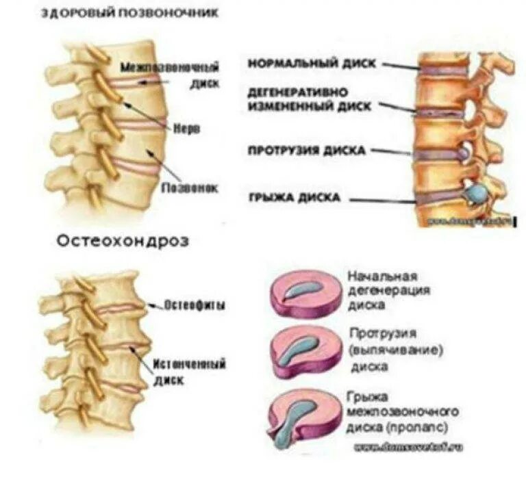 Хандроз или хондроз симптомы. Остеохондроз среднегрудного отдела позвоночника. Межпозвонковый остеохондроз поясничного отдела. Остеохондроз грудного отдела позвоночника симптомы. Остеохондроз шейно-грудного отдела позвоночника.