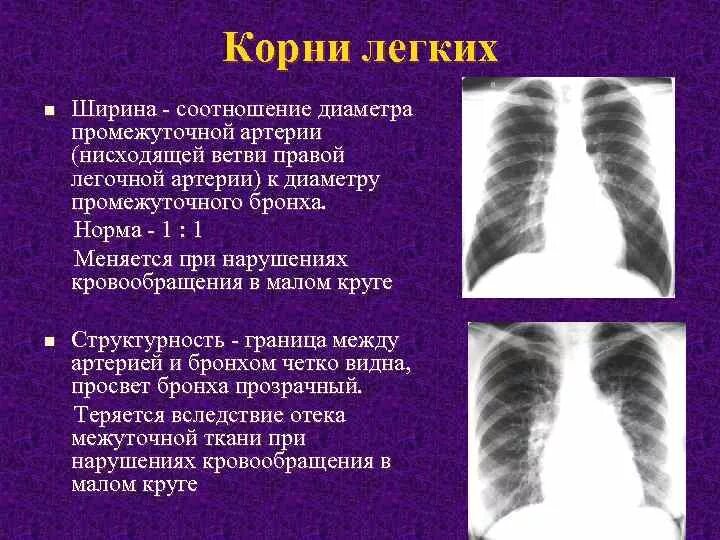 Корни усилены тяжисты. Обогащение легочного рисунка в прикорневой зоне. Корни усилены тяжисты. Корни усилены тяжисты. Корни усилены тяжисты.