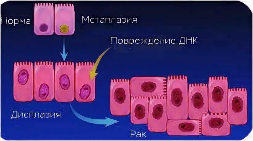 Цилиндроклеточная метаплазия. Цилиндроклеточная метаплазия пищевода с2м3. Цилиндроклеточная метаплазия очаговая.