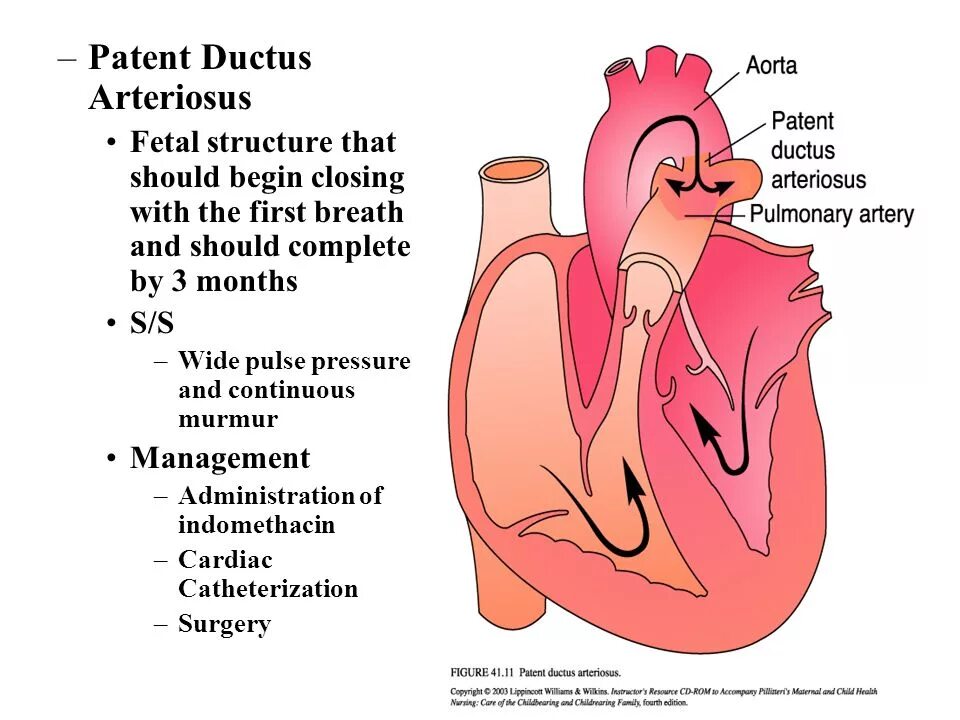 Plexus arteriosus. Patent ductus arteriosus. дуктус артериозус. дуктус зависимые пороки сердца у детей. у доношенного новорожденного ductus arteriosus закрывается.
