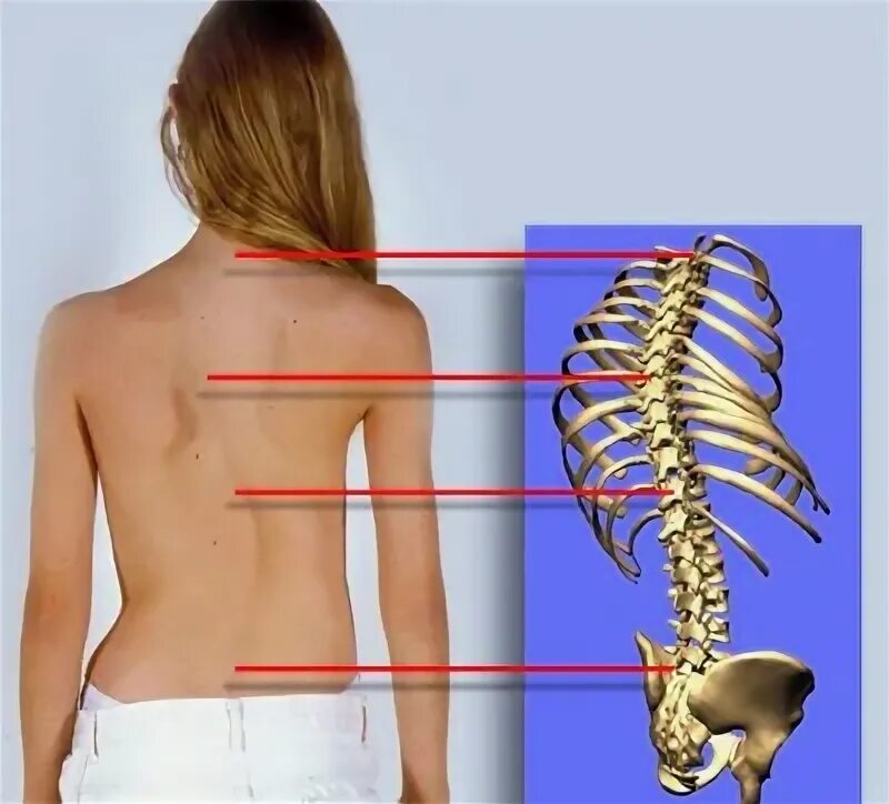 Сколиотическое искривление грудного отдела позвоночника. Сколиоз пояснично-крестцового отдела. Сколиоз позвоночника скелет. Деформации позвоночника ( сколиоз, лордоз, гиперкифоз).