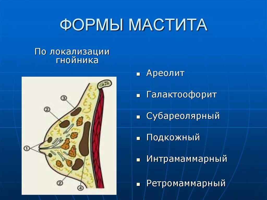 Мформв мастита. Острый гнойный мастит