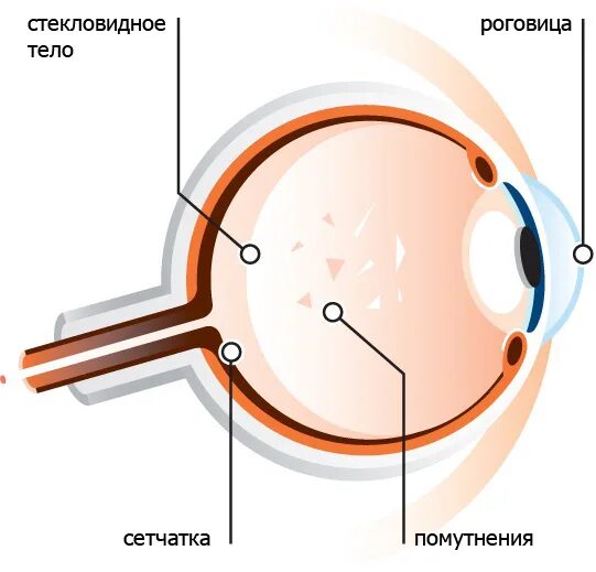 Деструкция стекловидного тела глаза. Миопия стекловидного тела. Холестероз стекловидного тела. Нитевидное помутнение стекловидного тела. Прозрачное тело в глазу