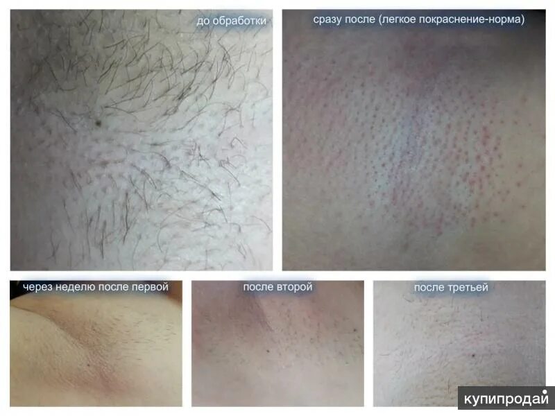 электроэпиляция - Фотография 10 из 10 ВКонтакте