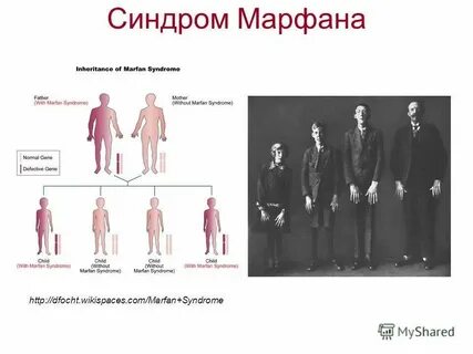Синдром марфана наследуется как аутосомно доминантный признак