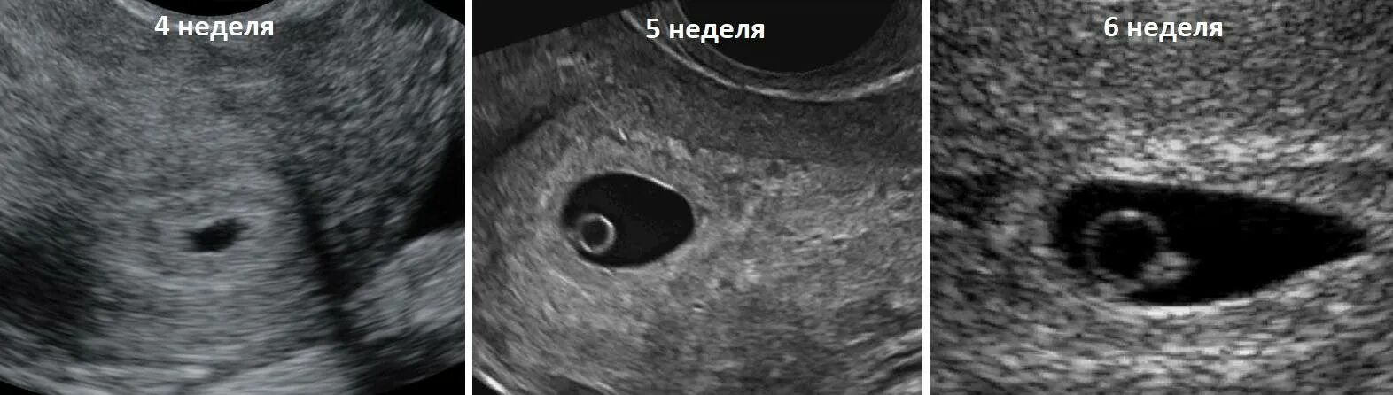 Забеременела 4 форум. 4 Эмбриональная неделя беременности УЗИ. Эмбрион на 5 неделе беременности УЗИ. Беременность 2-3 недели фото плода УЗИ. Эмбрион на 4 неделе беременности УЗИ.