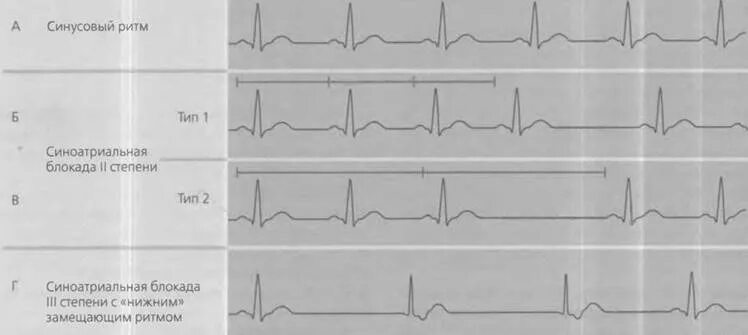 Са блокада типы. Синоатриальная блокада 2 степени на ЭКГ. Синоатриальная блокада 2 степени 2 типа на ЭКГ. ЭКГ при синоатриальной блокаде 3 степени. Синоатриальная блокада II степени Тип 1.