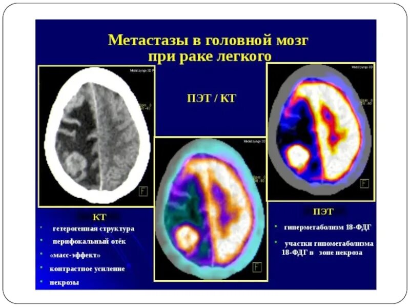 Оссифицированная менингиома. Диффузная глиома ствола головного. Опухоль мозга прогноз жизни. Анапластическая менингиома кт. Глиобластома 4 стадии неоперабельная.