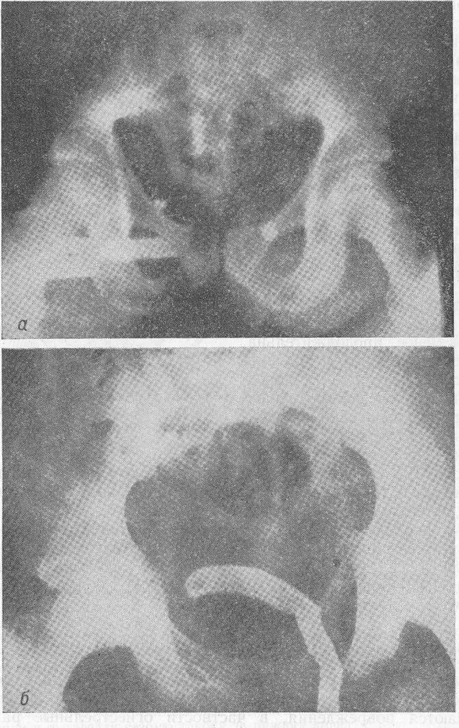 Сужение мочеиспускательного канала. Уретрография разрыв уретры. Разрыв луковичного отдела уретры. Проксимальная часть уретры.