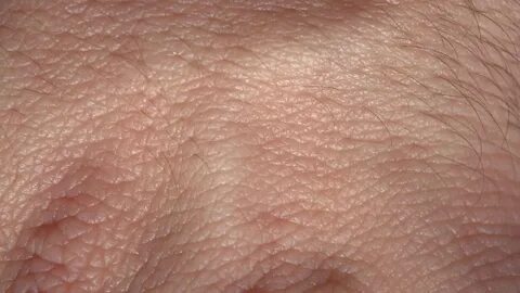 Рыхлая кожа