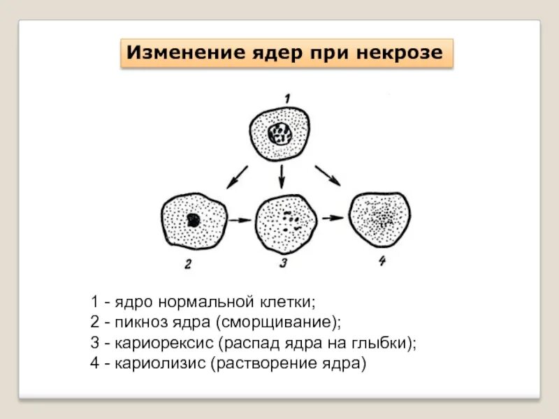 Растворение ядрышка. Стадии изменения ядра при некрозе. Изменение ядер клеток при некрозе. Схема гибели клеточного ядра. Схема гибели клеточного ядра при апоптозе.