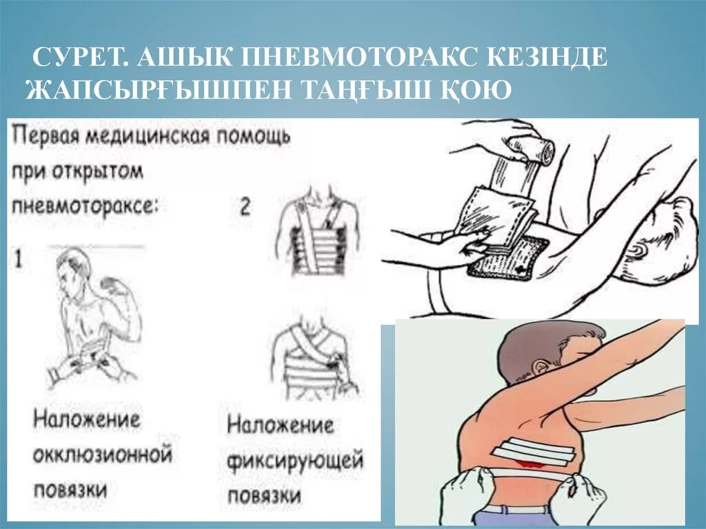 Наложение окклюзионной повязки при пневмотораксе. Наложение повязки при открытом пневмотораксе алгоритм. Наложить повязку при открытом пневмотораксе. Окклюзионной повязки при открытом пневмотораксе.