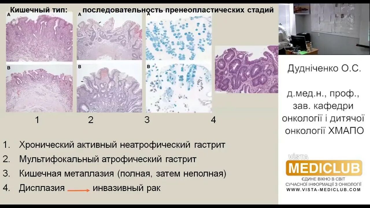 Метаплазия желудка отзывы. Полная кишечная метаплазия гистология. Кишечная метаплазия гистология. Метаплазия желудка гистология. Хронический гастрит гистология.