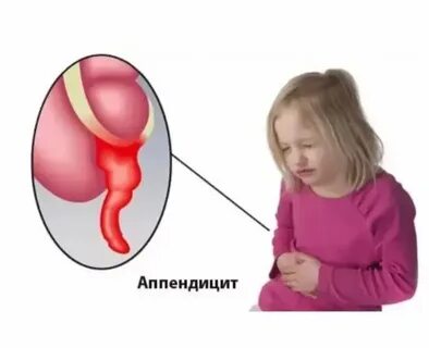 Аппендицит у детей фото