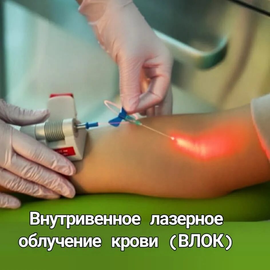 Лазерное облучение. Влок внутривенное лазерное облучение. влок внутривенное лазерное облучение крови. внутривенная лазерная терапия. внутрисосудистое лазерное облучение.