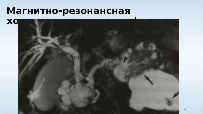 МРХПГ поджелудочной железы. Магнитно-резонансная холангиопанкреатография при ЖКБ. Магнитно резонансная холангиопанкреатография МРХПГ. Холангиопанкреатография мрт.