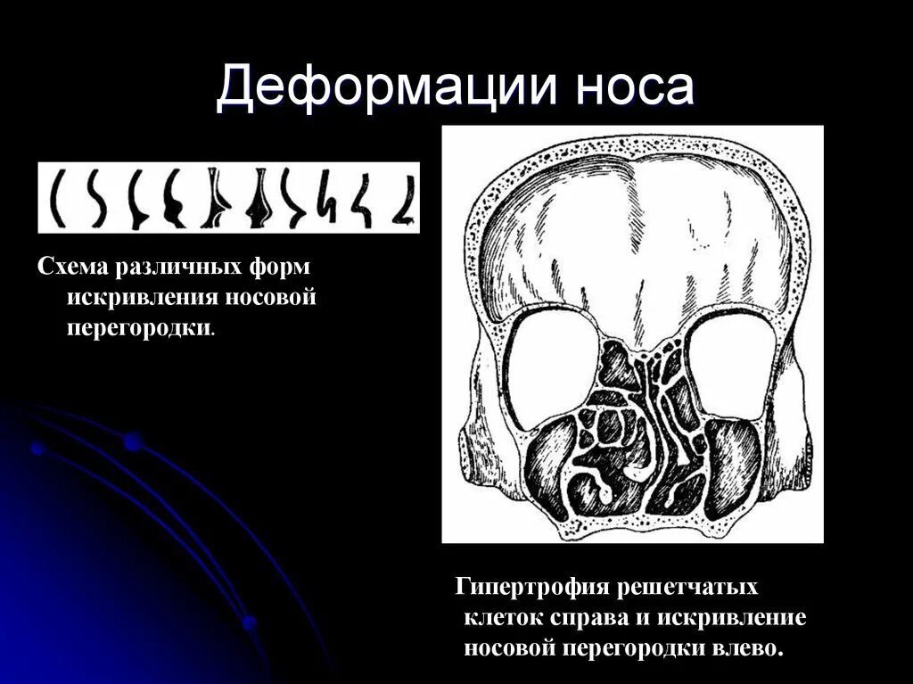 Деформация наружного носа. Степени искривления носа. Степени деформации наружного носа. Гипертрофия решетчатой кости. Носовая перегородка код по мкб 10