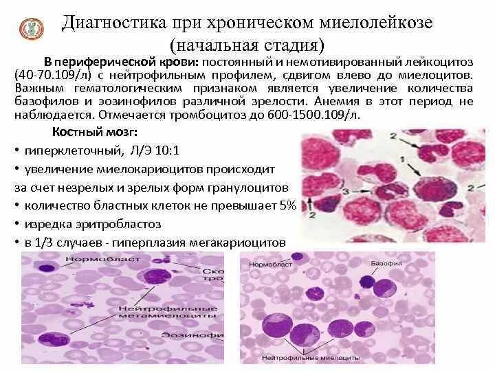 Культивирование лимфоцитов периферической крови. Хронический миелоидный лейкоз картина крови. Хронический миелоцитарный лейкоз (ХМЛ). Хронический миелолейкоз картина крови и костного мозга. Острый миелоидный лейкоз исследования крови.