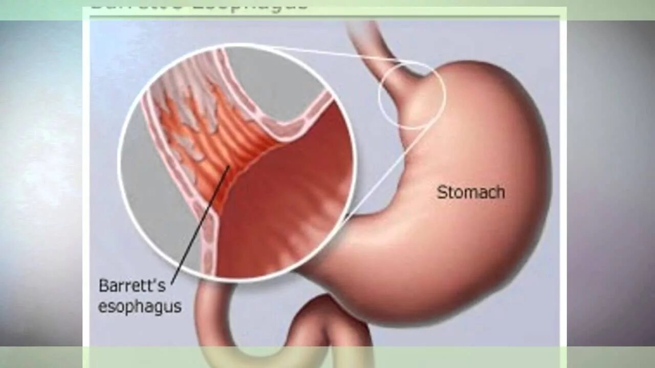 Пищевод баретта