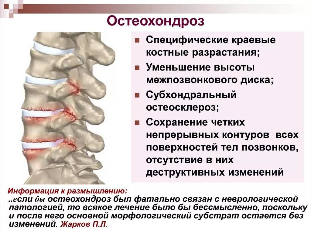 Краевые остеофиты углов тел с4-с6. Субхондральный остеохондроз. Краевые экзостозы позвоночника что это. Краевые остеофиты тел позвонков th5-th9..