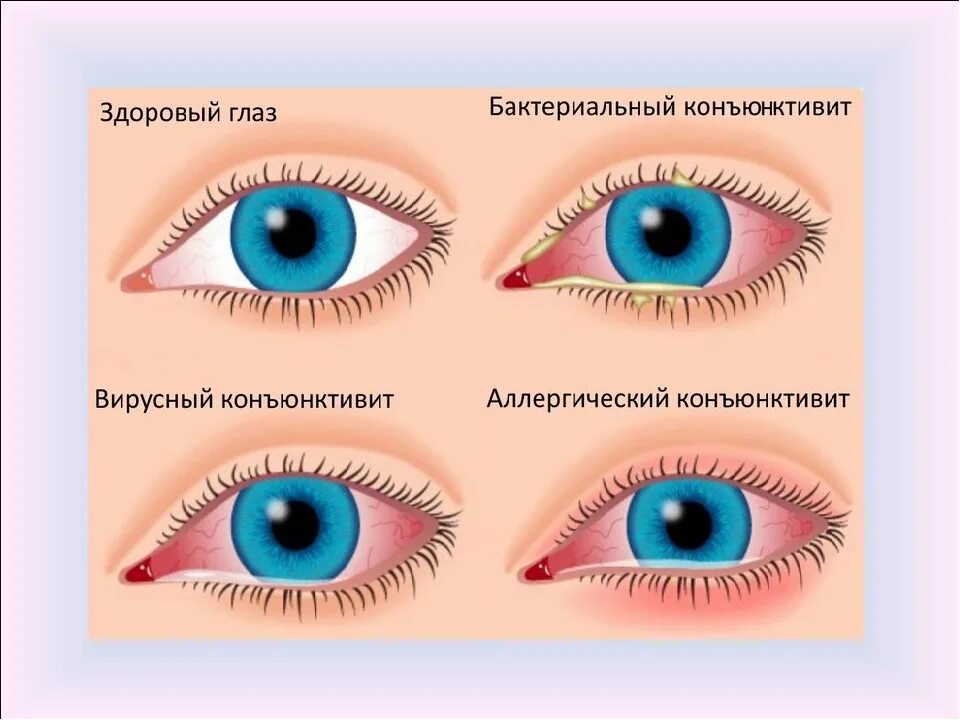 Воспаление века у ребенка. Красные круги под глазами. Вирусный конъюнктивит симптомы. Красные глаза при орви у ребенка. Аденовирусная инфекция конъюнктивит.