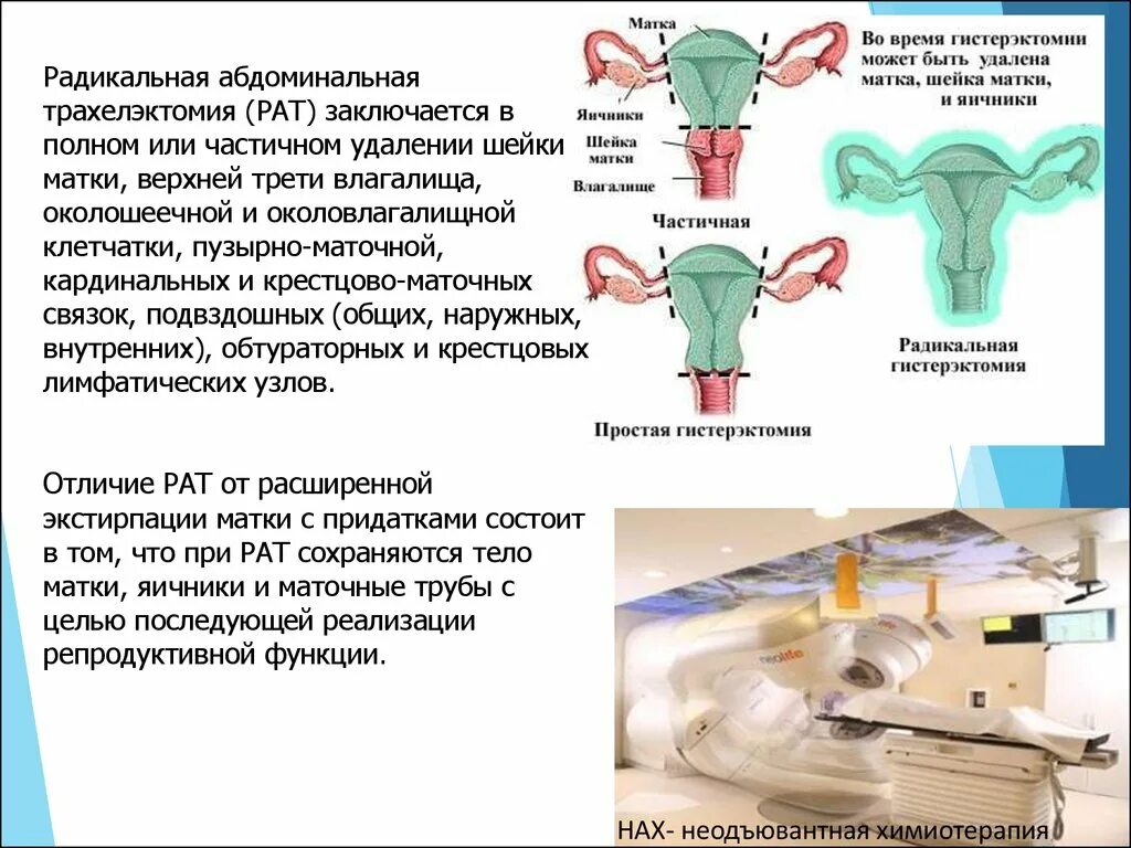 Ампутация и экстирпация матки. Экстрафасциальная экстирпация матки. Экстирпация матки с придатками. Гистерэктомия что это такое простыми словами