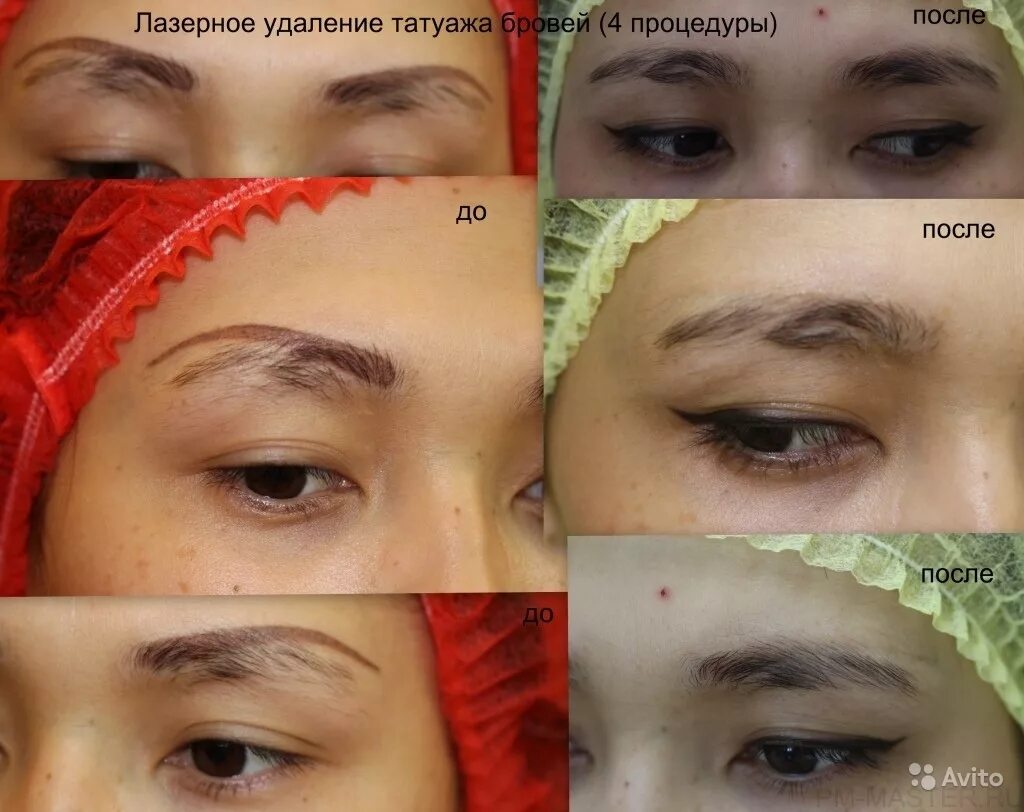 Как удалить татуаж бровей. Брови после лазера. удаление татуажа бровей лазером. брови после снятия татуажа. брови после удаления татуажа лазером.