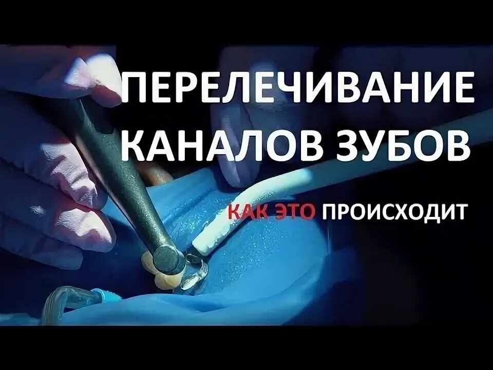 Перелечивание каналов зуба под микроскопом Исправление прикуса Инвизилайн. Удаление чужого импланта. Протезирование керамич