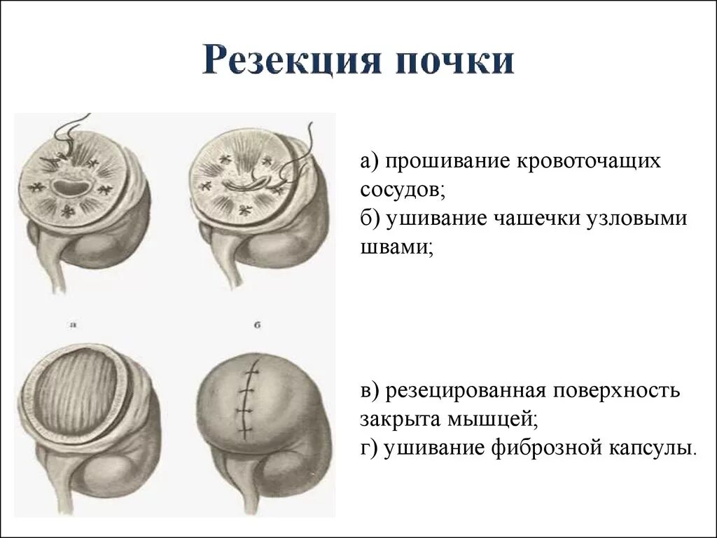 Резекция почки что это. Резекция почки (показания, техника выполнения).. Резекция почки Оперативная хирургия.