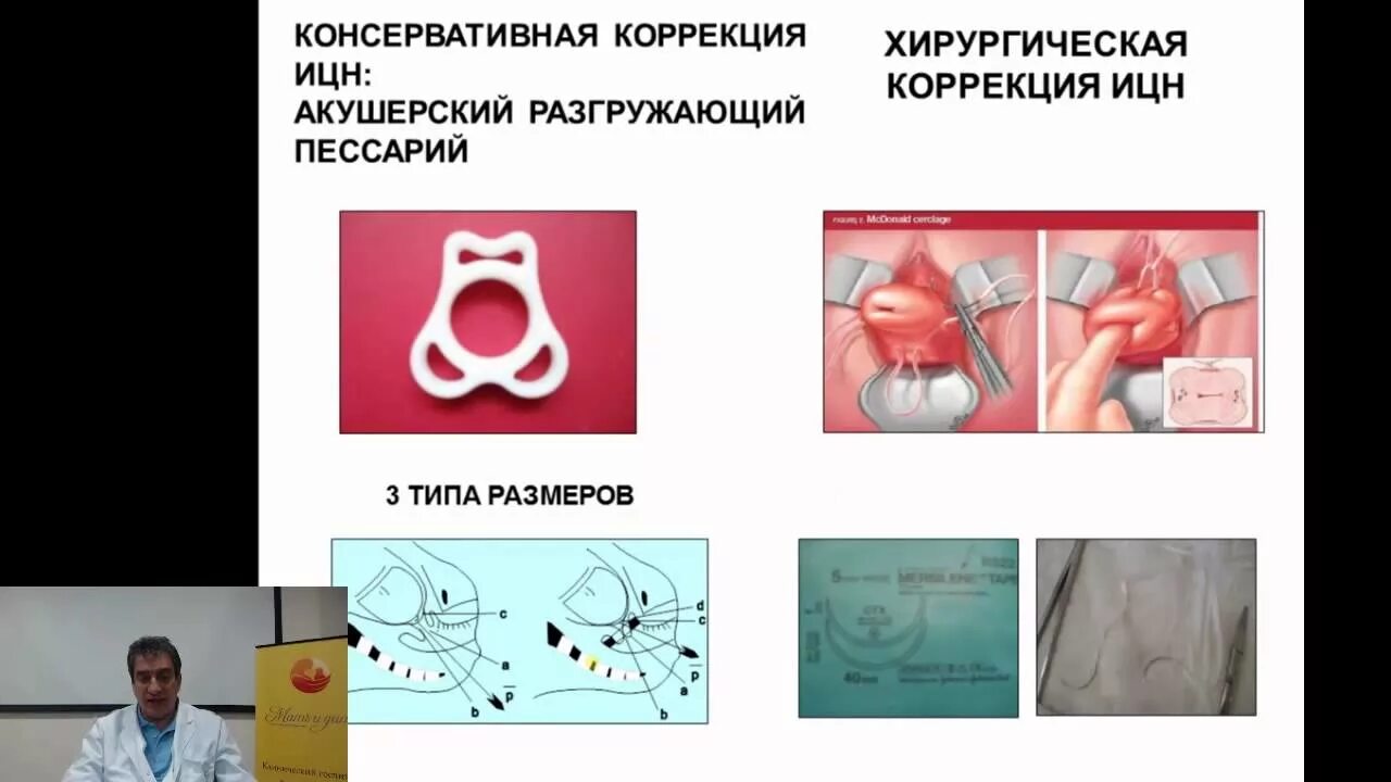 Методы хирургической коррекции ИЦН. Коррекция истмико-цервикальной недостаточности. Методы коррекции истмико-цервикальной недостаточности. Швы при ицн