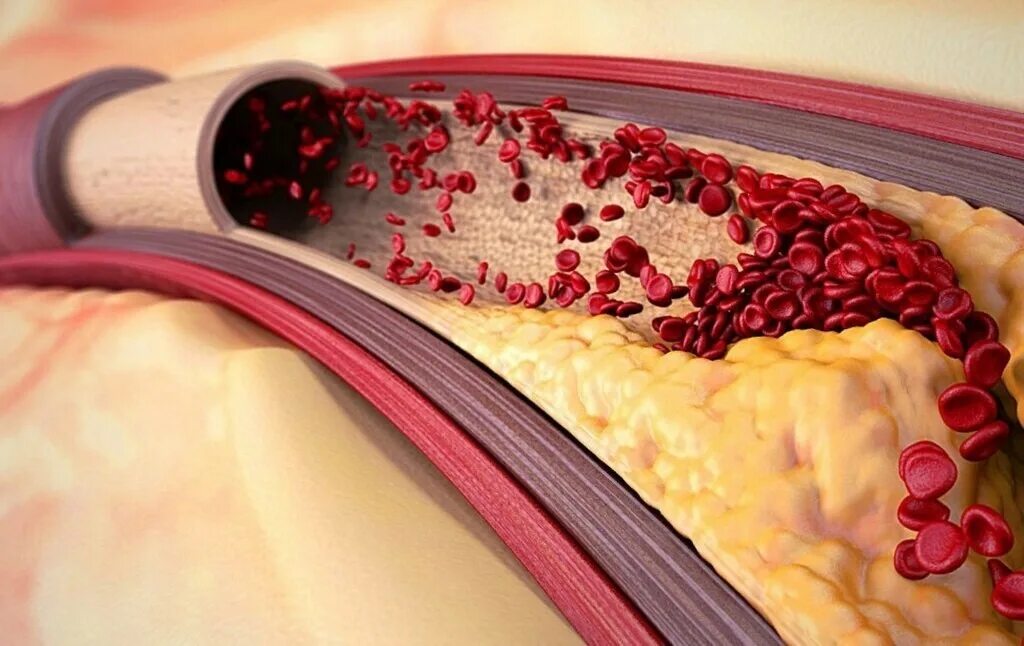 Что чистит кровь в организме. Атеросклеротическая бляшка. Кровяные бляшки в сосудах. Кровеносные сосуды от холестериновых бляшек;. Атеросклеротические бляшки в сосудах.