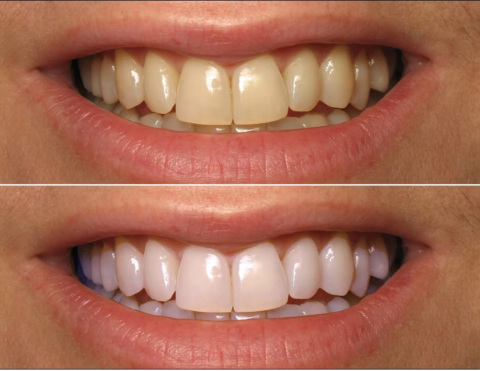 Отбеливание зубов до и после. Отбеливание зубов до Посл. Лазерное отбеливание до и после. Реставрация фотополимером