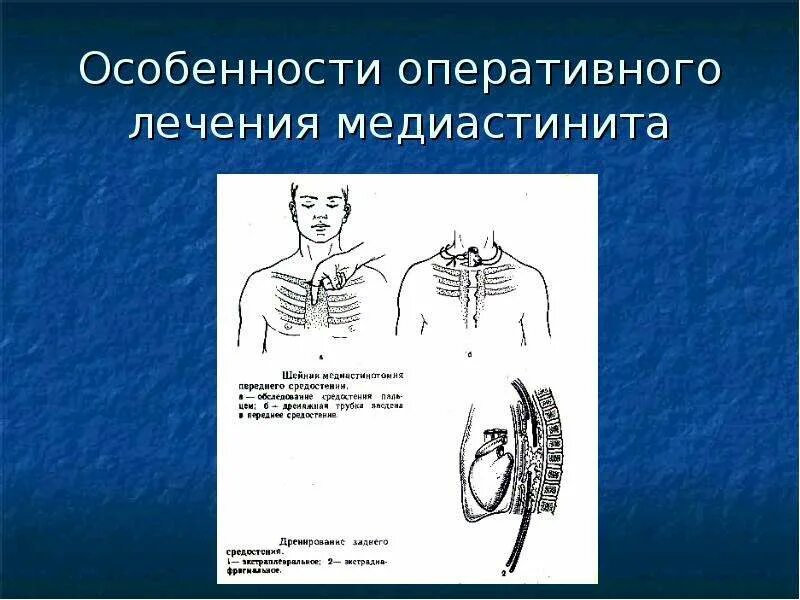 Медиастинит Госпитальная хирургия. Гнойный медиастинит хирургия. Дренирование медиастинита. Острый медиастинит лечение. Медиастинит лечение