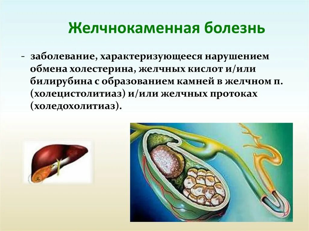 Жкб отзывы. Желчекаменная болезнь холелитиаз. Желчекаменная болезнь холедохолитиаз. Желчнокаменная полезен. Желчнокаменная болезнь (холелитиаз).