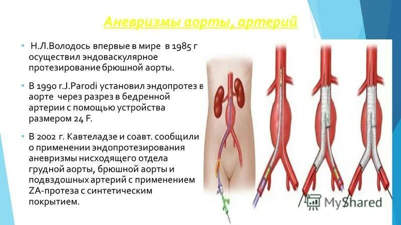 мешотчатая аневризма аорты. веретенообразная аневризма аорты. врожденная аневризма аорты. аневризма брюшной отдел аорты отделы. веретенообразная аневризма инфраренального отдела брюшной аорты.