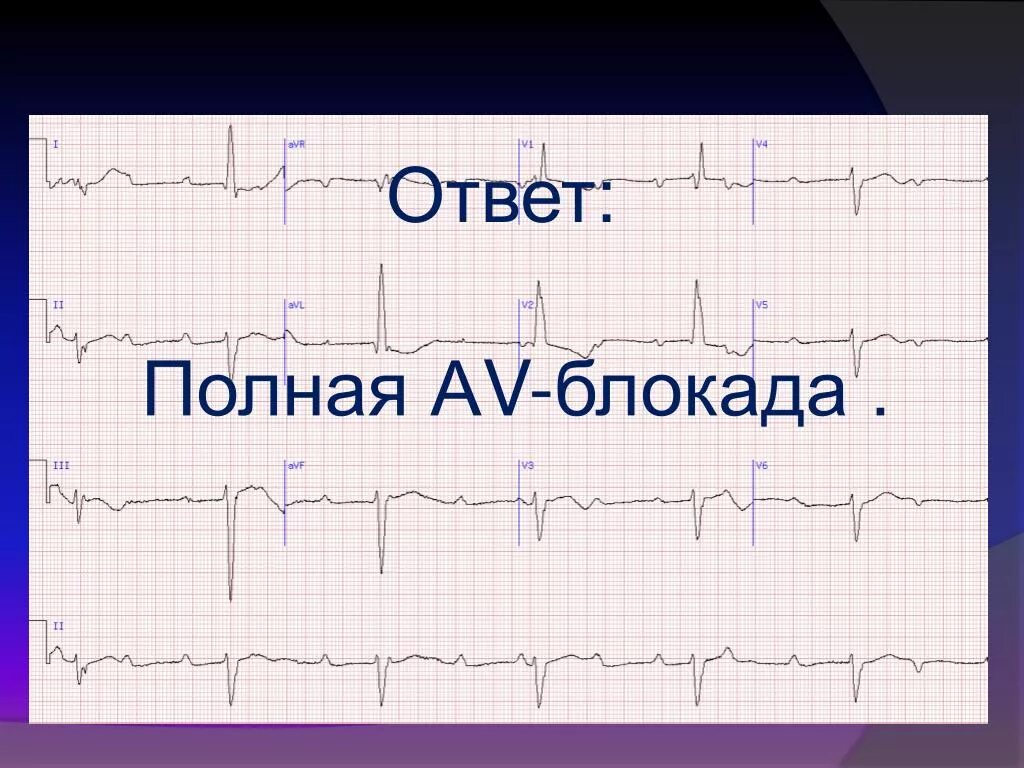 Блокада сердца это опасно. Полная блокада сердца. Блокада сердца группа. Полная вы блокада. Блокада сердца лекарства.