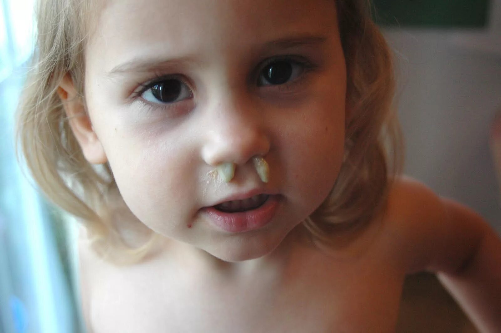 Почему образуются козявки в носу. Стрептодермия в носу у ребенка. Козюлька из носа у ребенка.