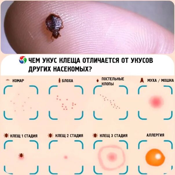 Укусы клопов как выглядят прыщи. Укусы насекомых у детей как выглядят. Как отличить укусы насекомых.