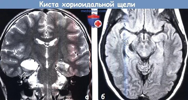 Субэпендимальная киста мрт. Киста в носовой пазухе на кт. Арахноидальная ликворная киста мрт. Субэпендимальная киста мрт. Опухоль головного мозга снимок мрт.