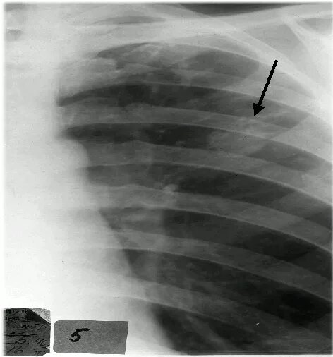 Туберкулема легкого рентгенограмма. Конгломератная туберкулома рентген. Туберкулез туберкулема. Рентген туберкулез туберкулема. Тени в верхней доле легкого