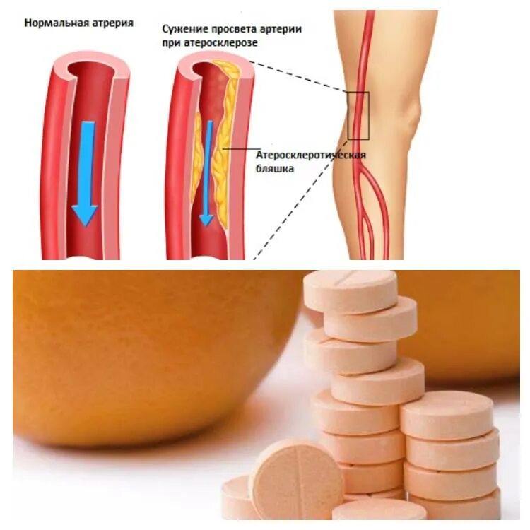 Медикаментозное лечение сосудов. Атеросклероз сосудов нижних конечностей препараты. Лекарство от атеросклероза сосудов. Медикаментозная терапия при атеросклерозе.