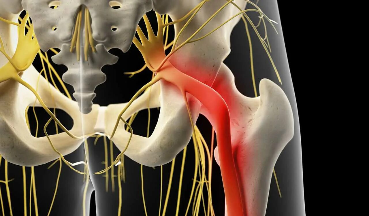 Бьется нерв. Седалищный нерв (sciatic nerve)?. седалищный нерв (sciatic nerve)? 011. ишиас анатомия. туннельный синдром седалищного нерва.