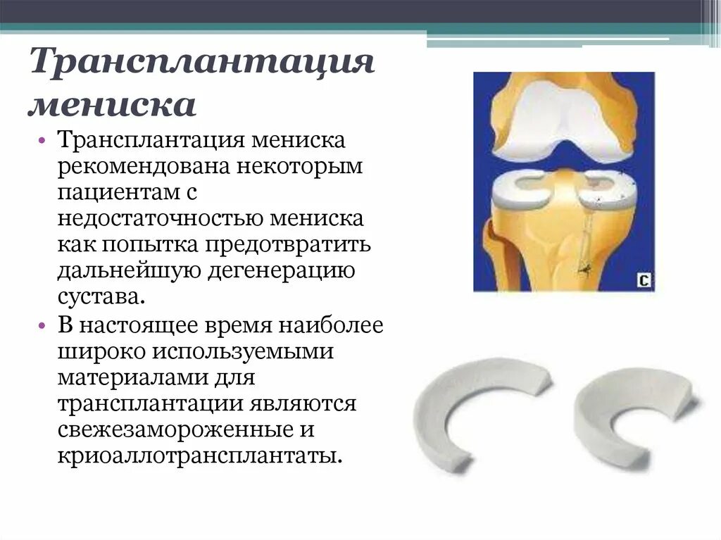 Дегенерация мениска. Имплант мениска коленного сустава. Протез мениска коленного сустава. Эндопротез мениска коленного сустава. Трансплантация мениска коленного сустава.