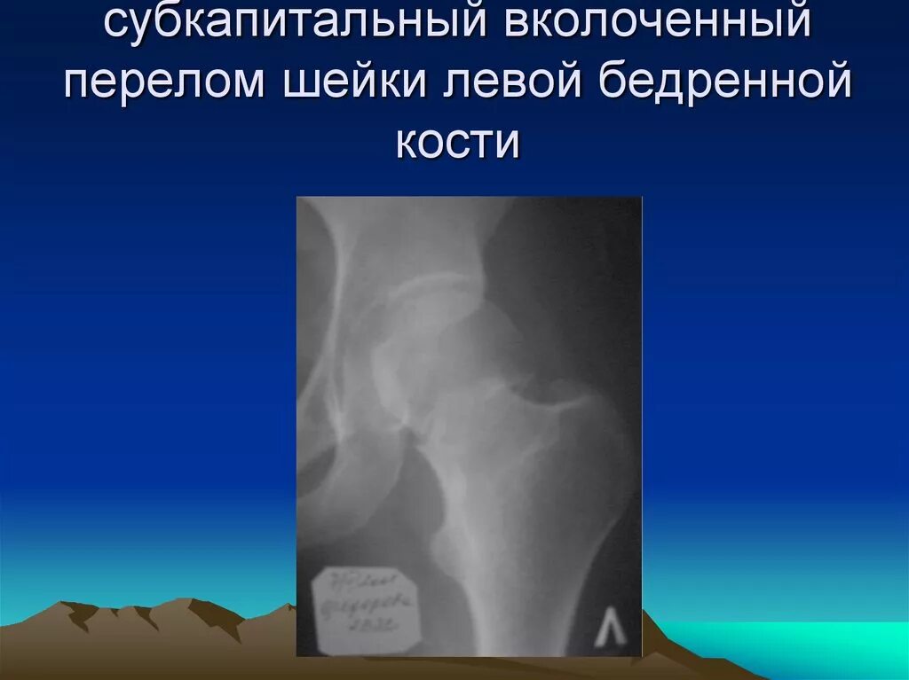 Субкапитальный перелом шейки бедренной кости. Вколоченный перелом шейки бедра классификация. Субкапитальный перелом шейки левой бедренной кости. Вколоченный чрезвертельный перелом. Трещина шейки